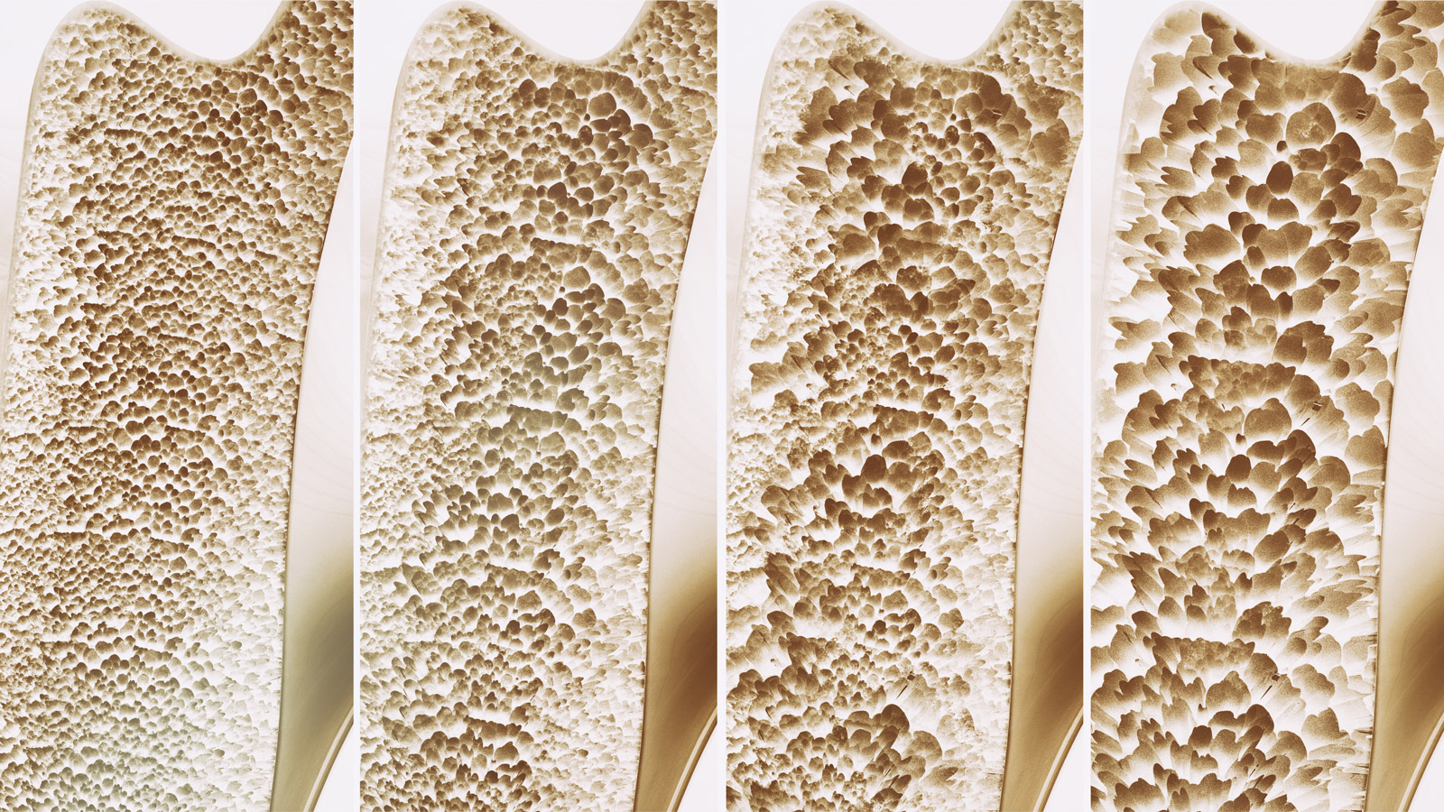 Are Osteoporosis Medications Safe to Take? Top 5 Supplements